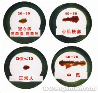 血栓檢測(cè)儀  MR-16加強(qiáng)型 血栓檢測(cè)儀